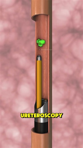 Renal Stones Treatment 3D Animation #renalstone #renalstones #renalstonesurgery #kidneystone