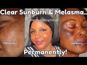 How to Treat Sunburn & Melasma FAST | Skincare Routine & Products That Work