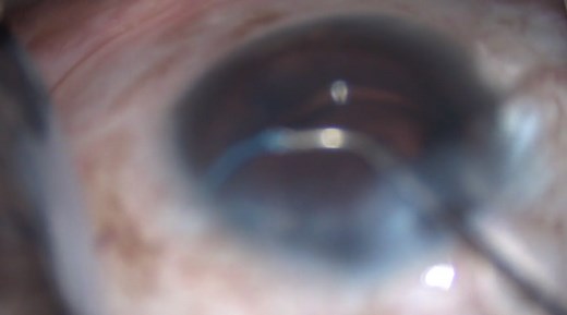 Viscocanaloplasty and Goniotomy - Eyetube