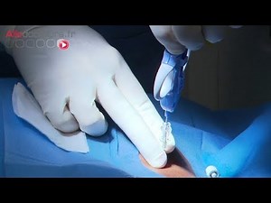 Lymphome : établir le diagnostic - Le Magazine de la santé