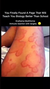 When Your Body Fights Back: Understanding Erythema Multiforme 🎯 #usa #biology