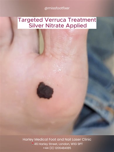 Persistent verruca undergoing professional treatment. The darkened tissue you see is silver nitrate: a topical application commonly used in podiatry to assist with lesion management. Careful debridement combined with targeted treatment helps reduce discomfort and encourage healthy skin recovery. Progress takes time but consistency and expert care make all the difference. #VerrucaTreatment #SilverNitrate #PlantarWartCare #PodiatryClinic #FootHealthExperts #ClinicalReels