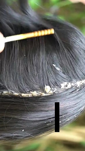 Dandruff treatment #DandruffScratching #ItchyDryScalp #HugeFlakes #Dandruff #dandrufftreatment #satisfying #dandruffremoval Disclaimer: Videos do not show original Dandruff,they are used for education purpose. Thank You,,,