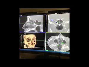 How to Interpret Your CT Scan