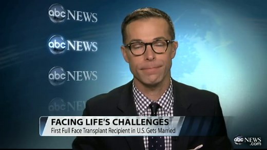 Full-Face Transplant Recipient Weds Burn Victim