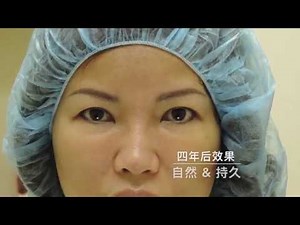 双眼不对称：非常自然持久的亚洲双眼皮手术 Asian Eyelid Surgery for Asymmetry and Balance by Chase Lay MD Chinese Version