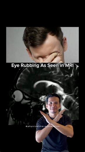 384K views · 2K reactions | Watch how our eyes look in an MRI when we rub them—and learn the proper way to do it. #physicaltherapy #viralvideoシ | Physical Therapy Session | Facebook