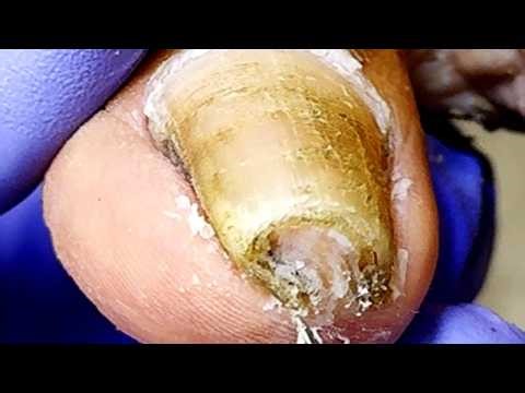 Wow, Long And Curly Toenails, Gentle Pedicure【Xue Yidao】