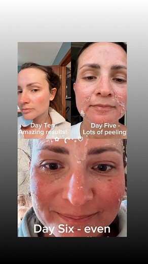 Give the gift of confident skin. VI PEEL🥰 The secret to picture-perfect skin this holiday season starts with 🎄VI Peel. Your go-to for smoother, brighter, more youthful-looking skin!❄ 🌞Fade dark spots 🌞Reduce fine lines and wrinkles 🌞Smooth texture & even tone Reveal your most confident glow in just 7-10 days because the brightest lights 💥of the season should be your skin! Call today to get on Lexy's or Adriana's schedule.......while they still have time.⏰ #VIPEEL #chemicalpeel #SkinVitalit