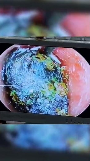 Best new pimple popping, cyst and blackhead extraction videos 2022 || Pimple time #63