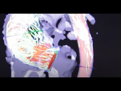 Understanding A Bicuspid Aortic Valve with Dr. Paul Fedak