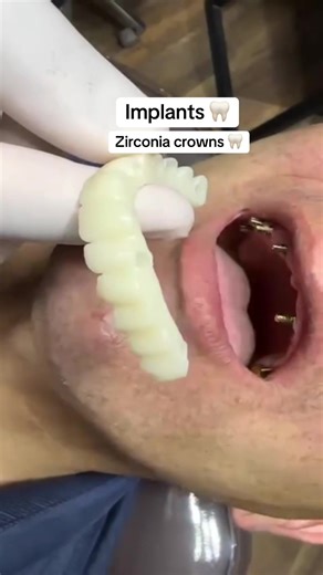 Understanding Zirconia Dental Implants and Crowns