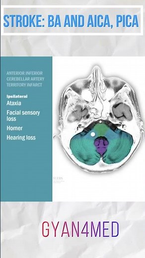Stroke : basilar artery and AICA, PICA