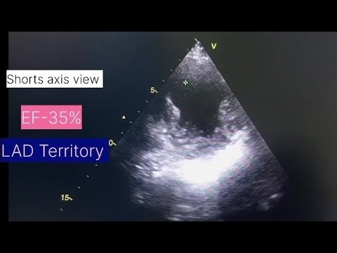 RWMA of Anterior wall Echo l हार्ट अटैक इको #echo #heartatttack By Babita