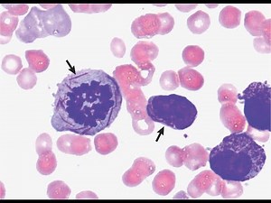 Auer rods needle shaped, crystalline cytoplasmic inclusions in myeloblasts & promyelocytes