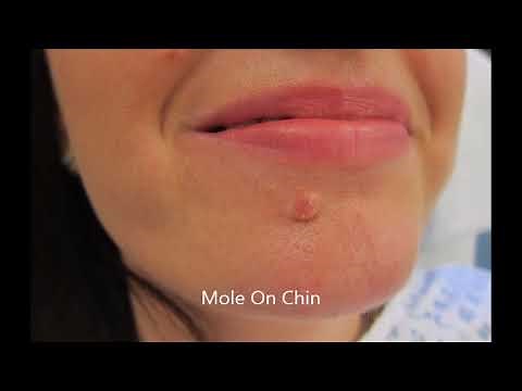 Shave or Excision of Your Mole