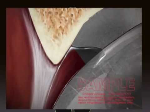 Metal-on-Metal Hip Replacement Recall Animation