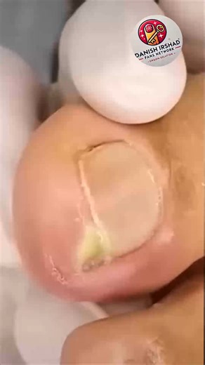 81K views · 396 reactions | Smart Health Tips for Senior Nail Care As Part of Holistic Wellness #WellnessSeniors #SeniorHealth #DiabeticFootCare #FootSupport | Danish irshad fans | Facebook