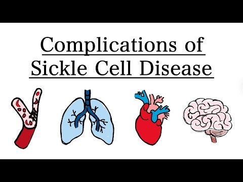 Sickle Cell Disease: Understanding Its Major Complications