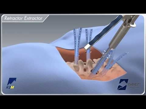 EVEREST® Minimally Invasive Surgical Technique Animation