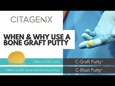 When to use a Dental Bone Putty Bone Graft for Oral Surgeries | Citagenix