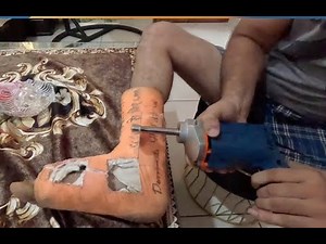 "Safe Plaster Removal at Home for Leg Casts | Step-by-Step Guide"