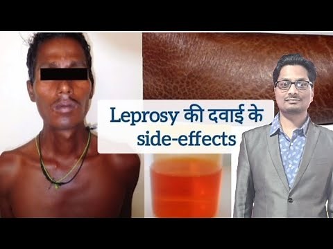 Leprosy की दवाइयों के side-effects | Dapsone | Clofazimine | Rifampicin | Hansen's disease #leprosy