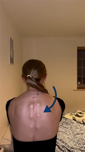 I have permanent titanium screws in my back 🔩🤯 #spine #metal #surgery | UNILAD Tech