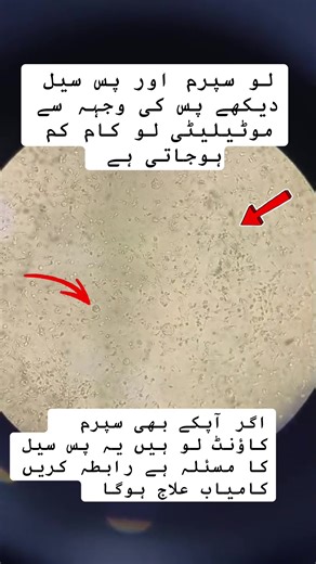 Understanding Low Sperm Count and Semen Analysis