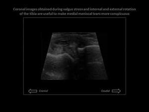 Meniscal tear and secondary parameniscal cyst on dynamic knee ultrasound