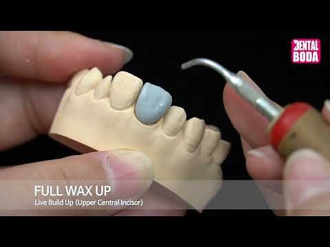 Full wax up (Upper Central Incisor)