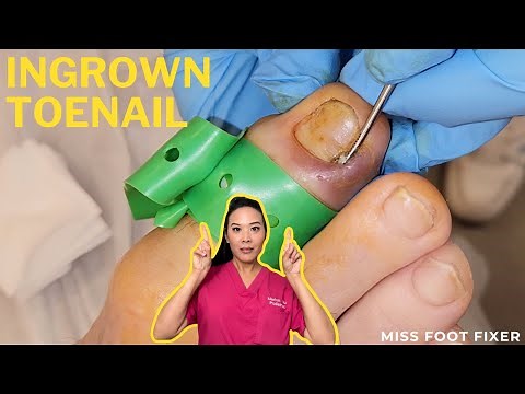Effortless Ingrown Toenail Removal - Pain-Free Treatment In Minutes! | Miss Foot Fixer