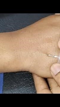 How to place a scalp vein set to give intravenous fluids | A complete procedure #medicalprocedures