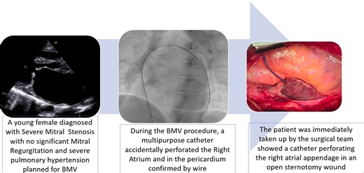 An Unexpected Right Turn: Multipurpose A2 Catheter Causing Right Atrial Perforation