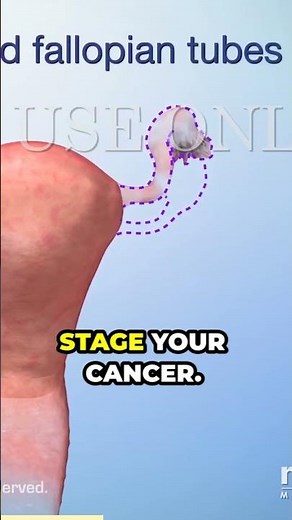 Surgery: The First Step in Cancer Treatment That Can Save Lives #surgeryrecovery