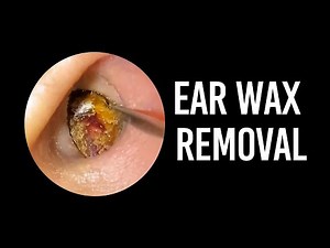 Large, multi ear wax successfully removed!