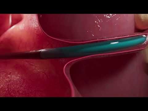 Audion ET dilation system technique