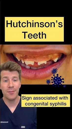 Hutchinson's teeth in congenital syphilis #shorts #health