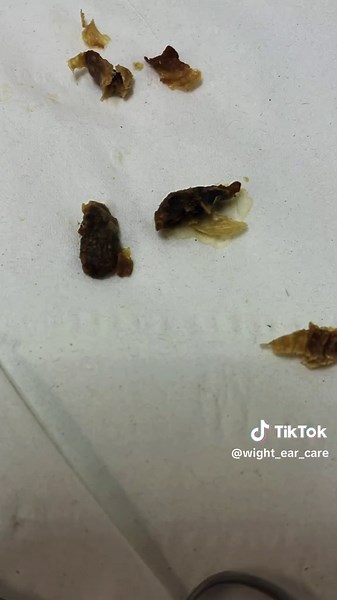 Earwax Removal Using Curette Method