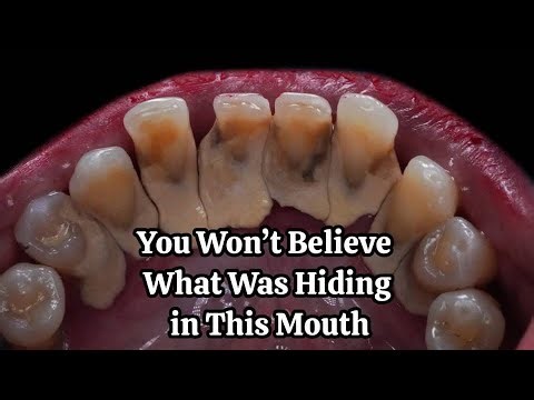 The Giant Tartar Removal Method That Brings Instant Relief #078