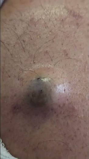 Multiple Familial Lipomatosis #imwell #medicaldoctor #drshashikant #lipomatosis #Lipoma 👨‍👩‍👧‍👦🩺