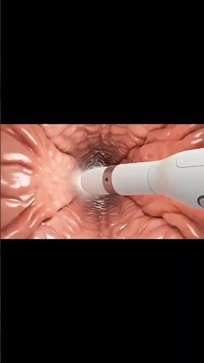 Upper Endoscopy Procedure – Watch the Complete 3D Demonstration!