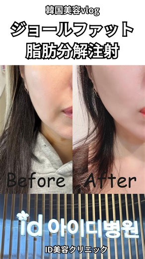 星野るり on Instagram: "【韓国美容】ジョールファット脂肪分解注射【ID美容クリニック】 韓国にきたらいつも打ってるジョールファットへの脂肪分解注射✨繰り返しの施術でもたつきが段々なくなって綺麗なフェイスラインへ！ 施術中痛みはあるし、直後は少し腫れて段々効果が現れるけど、人生で7回目くらいの施術でだいぶ変化があったよ✨ 慣れてる先生に施術してもらうのが安心でオススメ！ 綺麗なクリニックで立地も◎ビル丸ごとクリニックだから見つけやすい👍 日本語通訳常駐だから安心！ ありがとうございました！ 📍新沙駅1番出口徒歩約2分 @id_clinic_jp @id_clinic_sinsa 予約はこちらから▶︎ @idhospital_jp #韓国肌管理 #渡韓美容 #韓国id美容クリニック #脂肪分解注射"