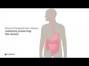 Creation of end colostomy by removing sigmoid colon | Ostomy surgery | Coloplast India