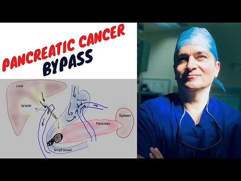 BYPASS FOR PANCREATIC CANCER (What, why and when)