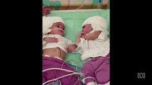 Conjoined twins see each other for the first time after rare separation surgery