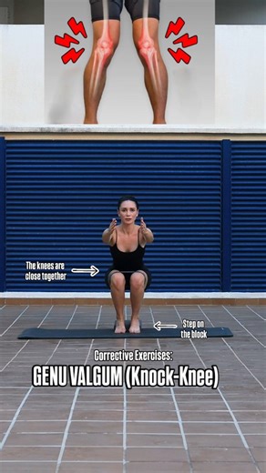 Genu valgum, also known as knock knees, is a condition where the knees angle inward and touch each other while the ankles stay apart. It can result from muscle imbalances, poor alignment, or joint weakness. Over time, it may cause knee, hip, or ankle pain. Strengthening the hips and glutes, improving leg alignment, and working on balance can help correct the position and reduce strain on the joints. Narrow squats help with knock knees correction by strengthening the glutes, quadriceps, and inner