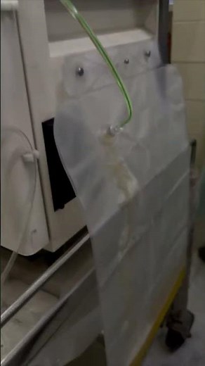 Plasma Exchange Procedure in 60 Seconds