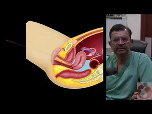 Locating fibroids during laparoscopic myomectomy • Video • MEDtube.net