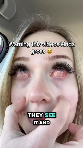 Why Your Eye Suddenly Turns Red 😳👁️